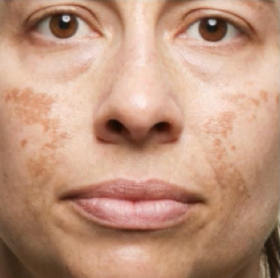 Cheek with visible dark spots before Morning Cocktail Vitamin C Serum use