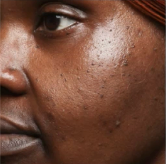 Cheek with dark post-acne spots before Morning Cocktail Vitamin C Serum use