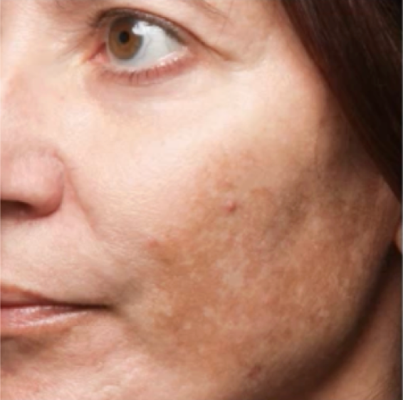 Cheek with an uneven dark patch before Morning Cocktail Vitamin C Serum use