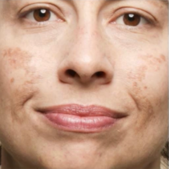 Same cheek with visibly faded dark spots after 4 weeks of Morning Cocktail Vitamin C Serum