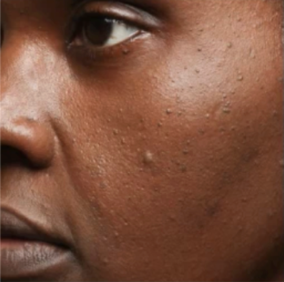 Same cheek with visibly faded dark spots after 4 weeks of Morning Cocktail Vitamin C Serum