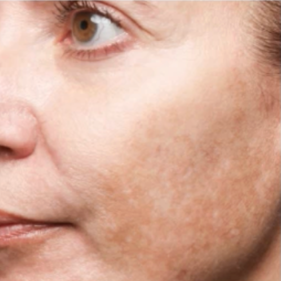 Same cheek with a visibly lighter, more even tone after 4 weeks of Morning Cocktail Vitamin C Serum