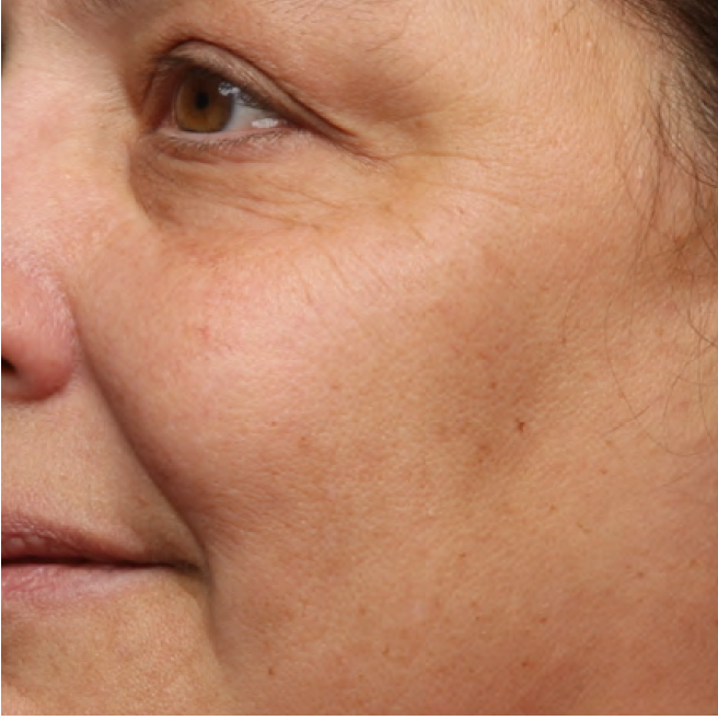 Cheek with visible fine lines before Last Call Retinol Serum use