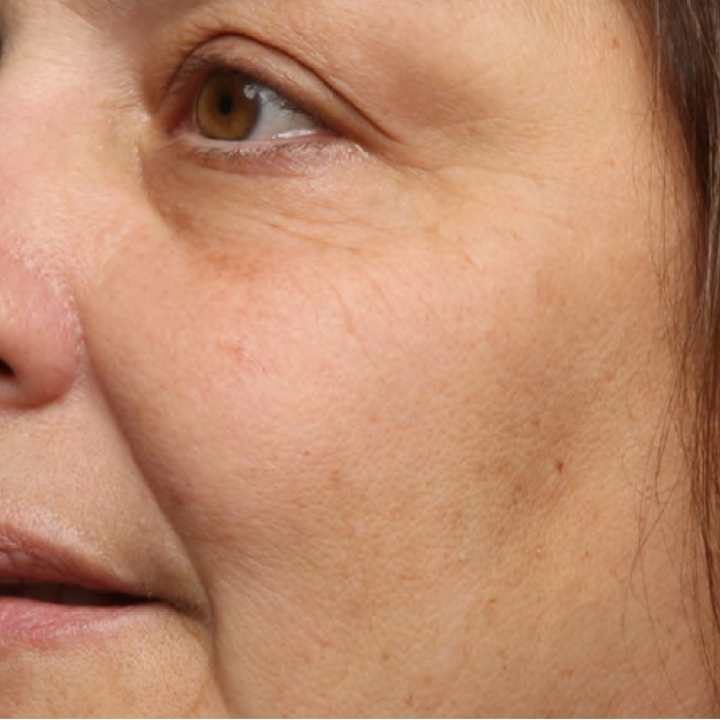 Same cheek with visibly smoother, finer lines after 4 weeks of Last Call Retinol Serum