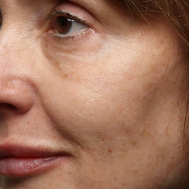 Cheek with visible fine lines before Last Call Retinol Serum use