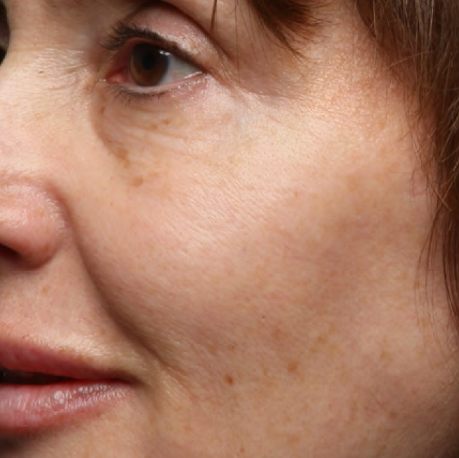Same cheek with visibly smoother, finer lines after 4 weeks of Last Call Retinol Serum