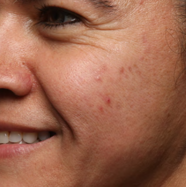 Cheek with visible redness and blemishes before Last Call Retinol Serum use