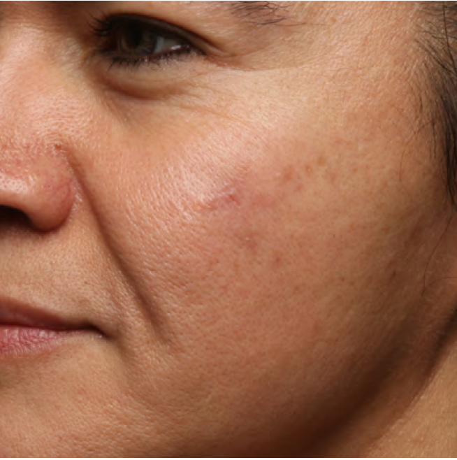Same cheek with visibly calmer, more even skin after 4 weeks of Last Call Retinol Serum