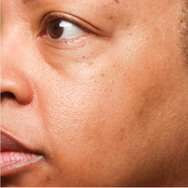 Cheek with mild dark spots before Problem Solver Tranexamic Dark Spot Cream use