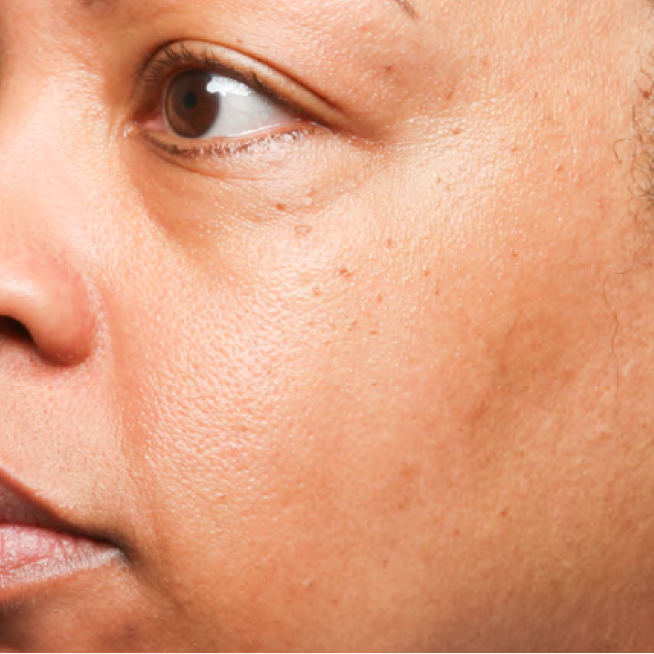 Same cheek with visibly reduced dark spots after 4 weeks of Problem Solver Tranexamic Dark Spot Cream