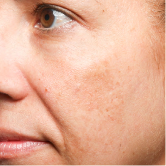 Cheek with mild dark spots before Problem Solver Tranexamic Dark Spot Cream use