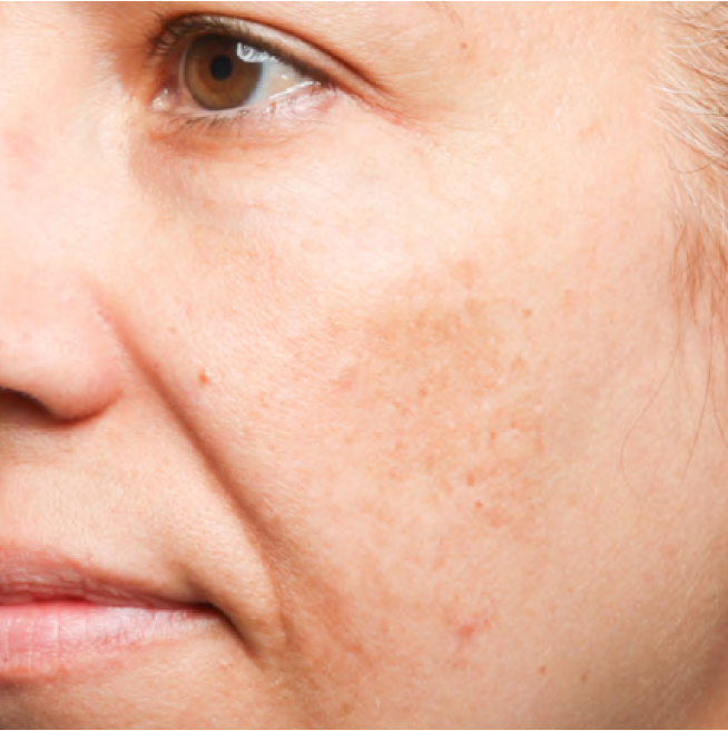 Same cheek with visibly reduced dark spots after 4 weeks of Problem Solver Tranexamic Dark Spot Cream