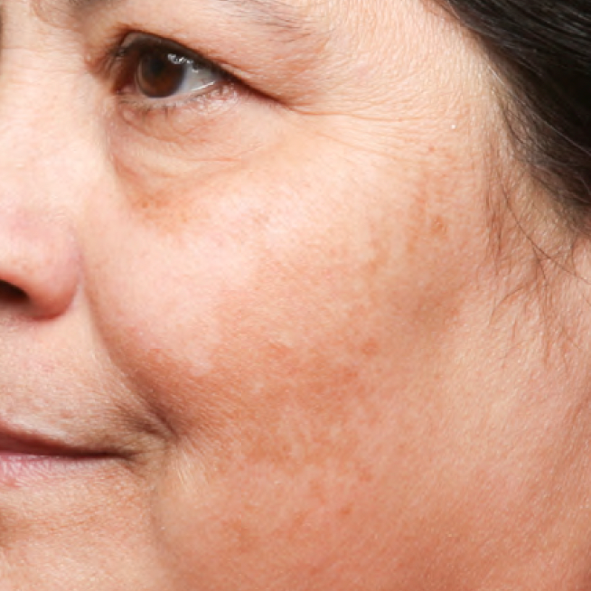 Cheek with a dark pigmented patch before Problem Solver Tranexamic Dark Spot Cream use