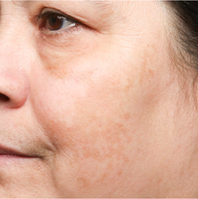 Same cheek with the dark patch visibly faded after 4 weeks of Problem Solver Tranexamic Dark Spot Cream