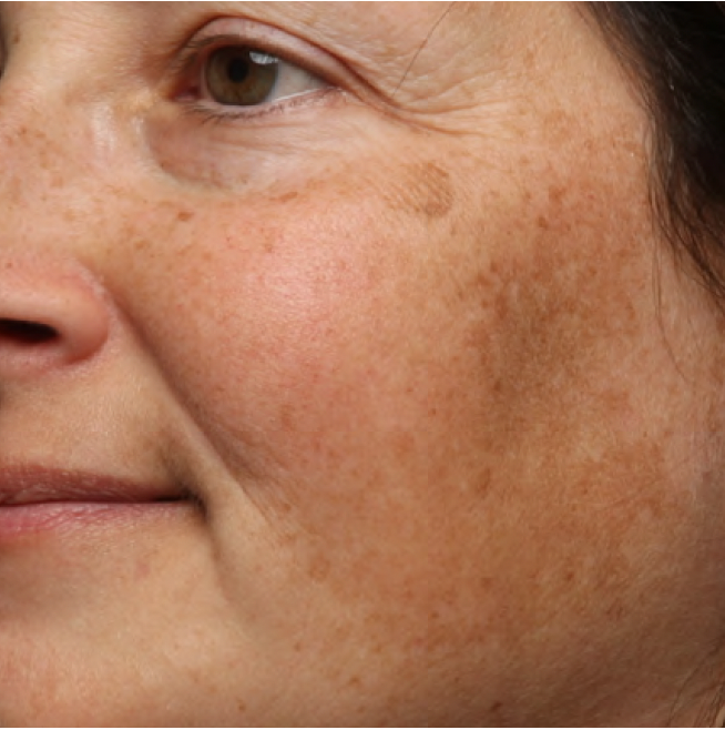 Cheek with uneven, hyperpigmented texture before Your Favorite Ex Exfoliating Pads use