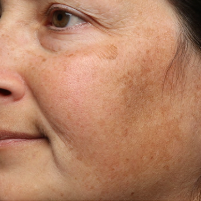 Same cheek with smoother, more even-looking skin after 4 weeks of Your Favorite Ex Exfoliating Pads