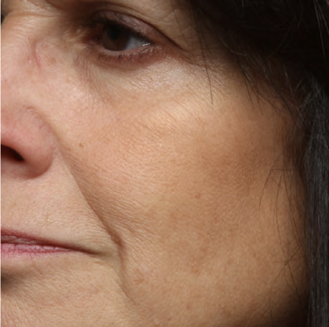 Same cheek with smoother, more even-looking skin after 4 weeks of Your Favorite Ex Exfoliating Pads