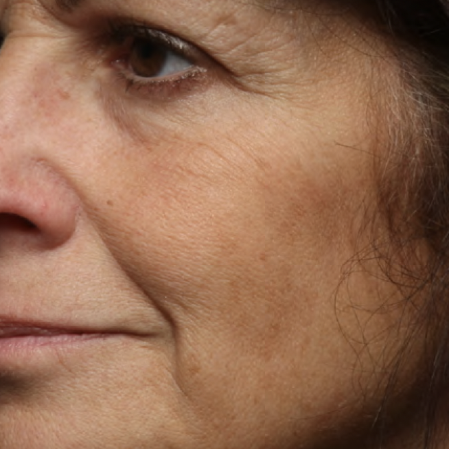 Cheek with uneven texture before Your Favorite Ex Exfoliating Pads use