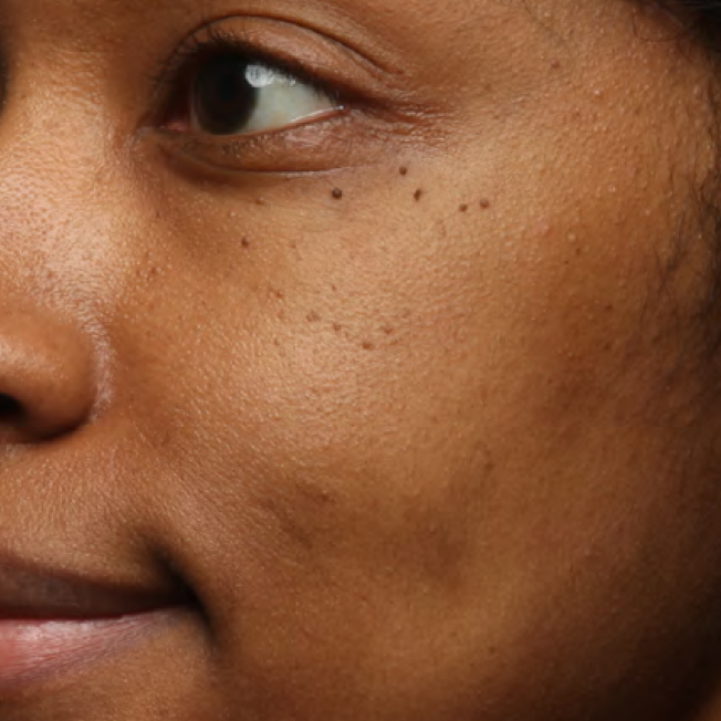Cheek with visible dark marks before Your Favorite Ex Exfoliating Pads use