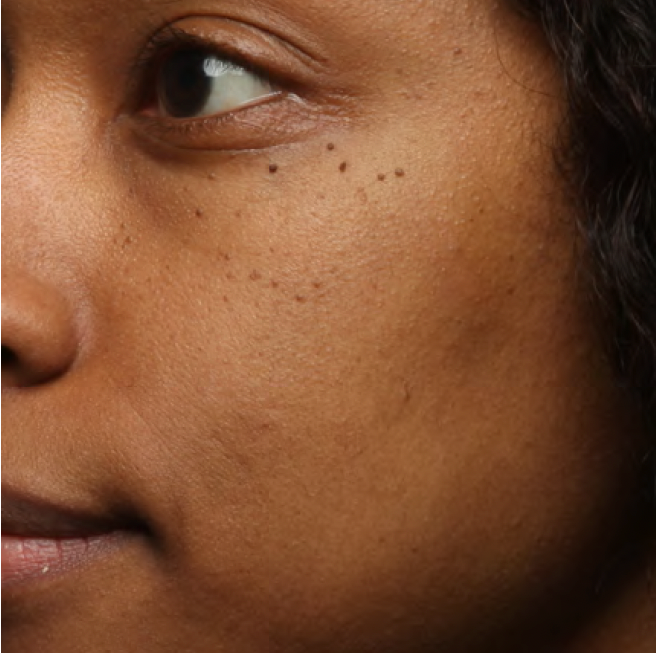 Same cheek with visibly smoother skin after 4 weeks of Your Favorite Ex Exfoliating Pads
