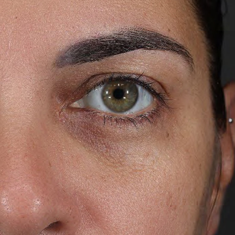 Same under-eye area with visibly brighter, less discolored skin after 4 weeks of Wide Awake Brightening Eye Cream