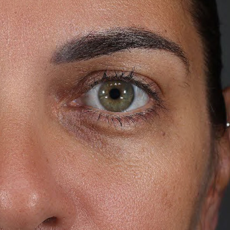 Under-eye area with visible dark circles before Wide Awake Brightening Eye Cream use