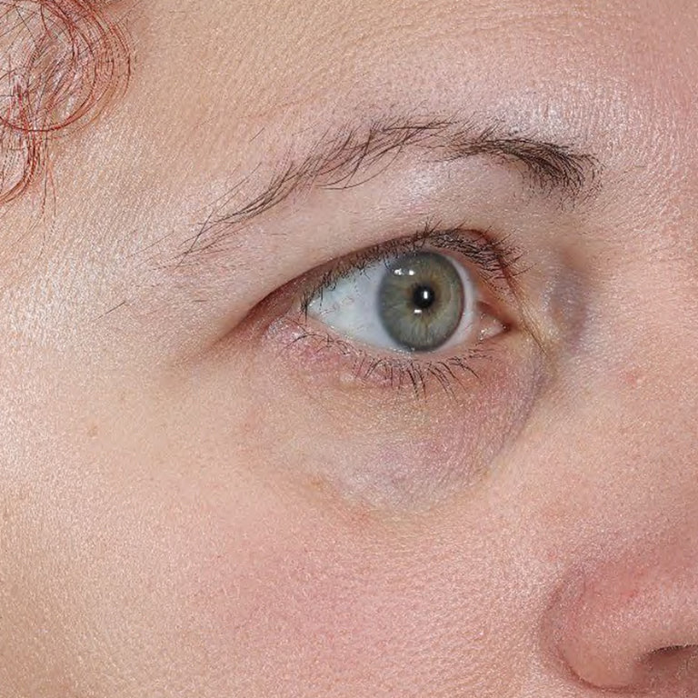 Same under-eye area with visibly brighter skin after 4 weeks of Wide Awake Brightening Eye Cream