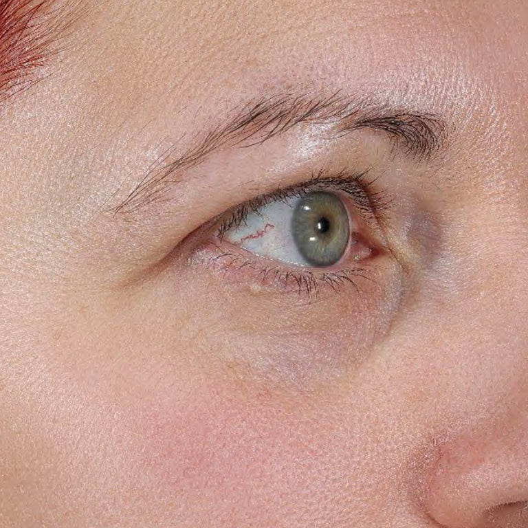 Under-eye area with visible dark circles before Wide Awake Brightening Eye Cream use