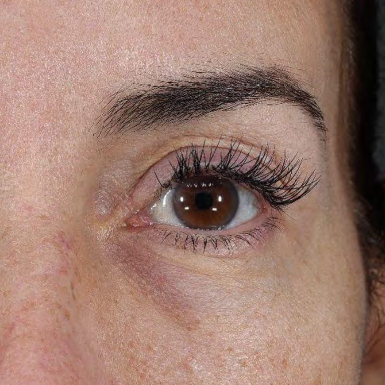 Under-eye area with visible dark circles before Wide Awake Brightening Eye Cream use