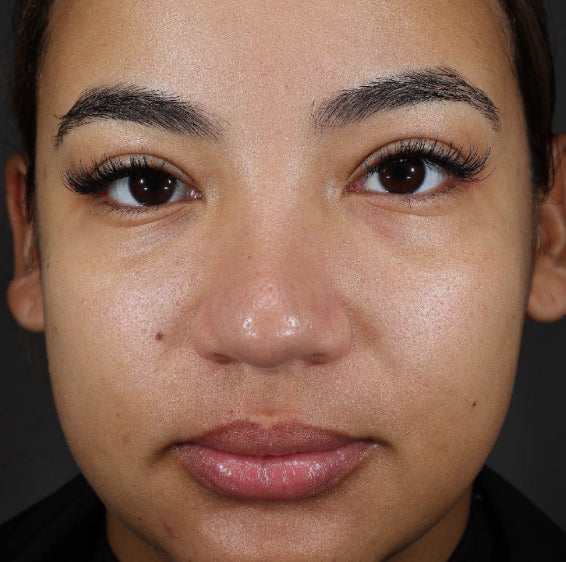Same face with visibly plumper, dewier-looking skin after 4 weeks of Xtreme Glow Dewy Peptide Plumping Serum