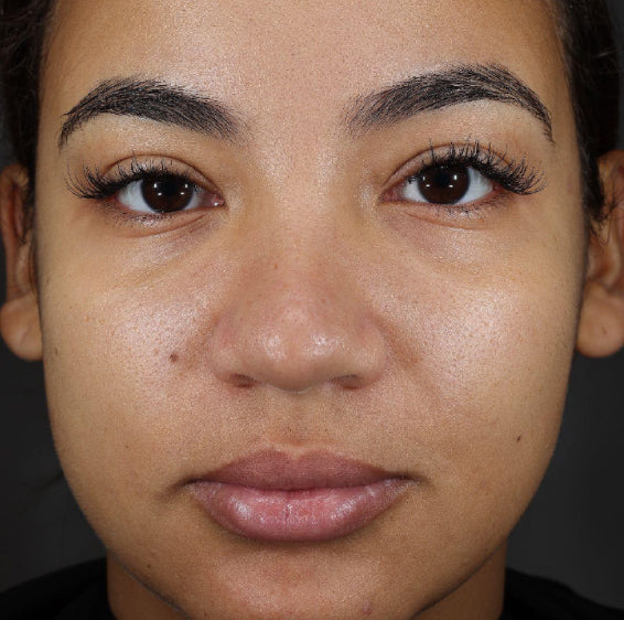Face with visible under-eye hollows before Xtreme Glow Dewy Peptide Plumping Serum use