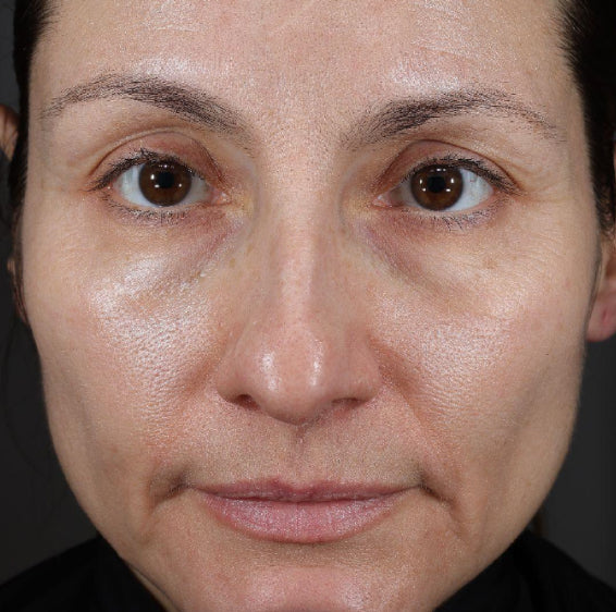 Same face with visibly plumper, dewier-looking skin after 4 weeks of Xtreme Glow Dewy Peptide Plumping Serum