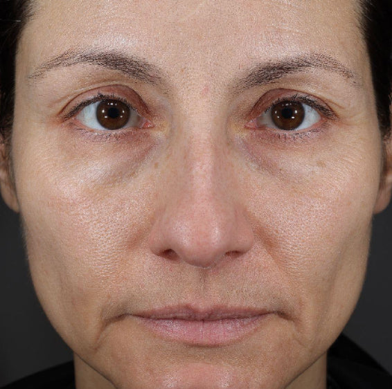 Face with visible under-eye hollows before Xtreme Glow Dewy Peptide Plumping Serum use