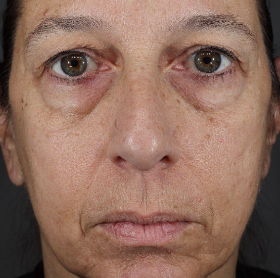 Same face with slightly plumper-looking under-eye area after 4 weeks of Xtreme Glow Dewy Peptide Plumping Serum
