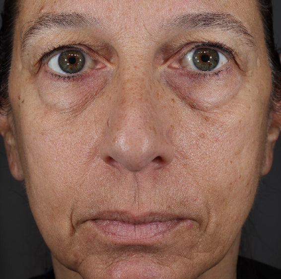 Face with visible under-eye hollows before Xtreme Glow Dewy Peptide Plumping Serum use